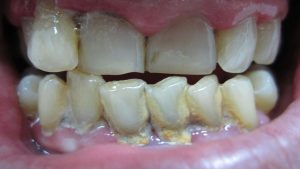periodontito gydymas