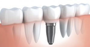 soninio danties implantavimas
