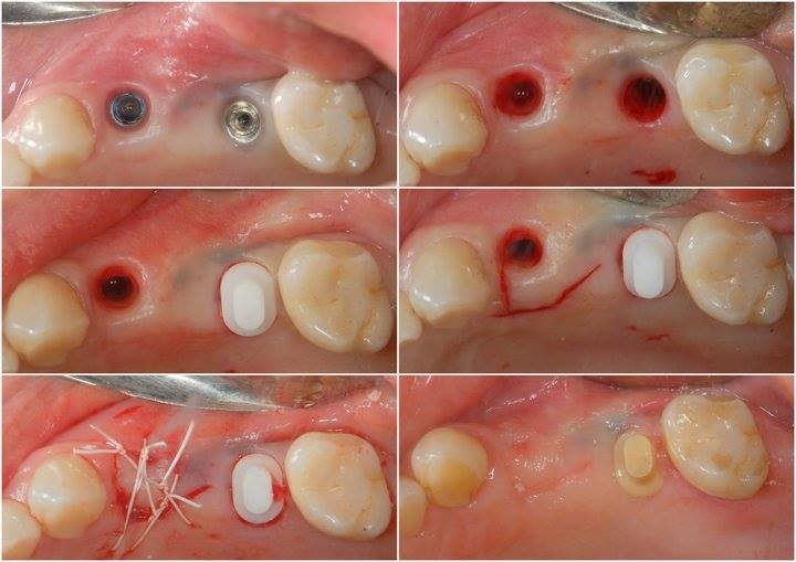 danties implanto pasalinimas