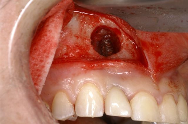 danties implanto atmetimo pozymiai