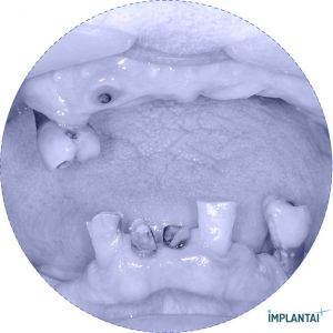 atvejis Dental Implantai Implantaiplius