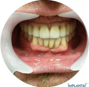 atvejis Dental Implantai Implantaiplius